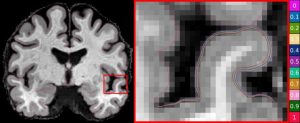 World first brain test developed in Qld