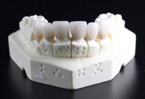 Fanelli Dental have the solution for missing teeth